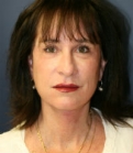 Feel Beautiful - Facelift San Diego Case 20 - After Photo